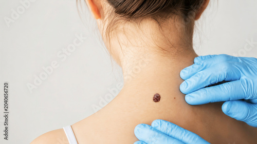 Fotografie Dermatologist in blue gloves examining a prominent brown mole on a woman's upper