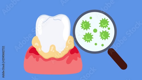 bacterial layer of plaque forming on enamel surface