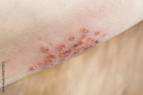 Woman with shingles on the skin she feels very painful. High quality photo