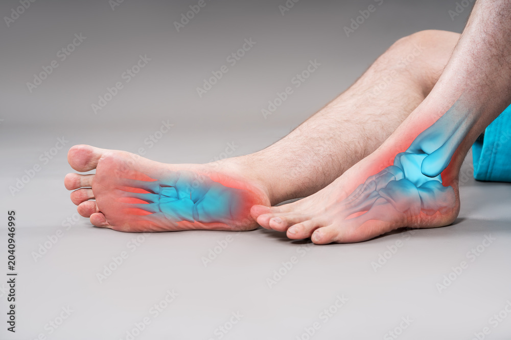 Fototapeta premium Joint diseases, hallux valgus, plantar fasciitis, heel spur, leg hurts, pain in the foot, male feet closeup