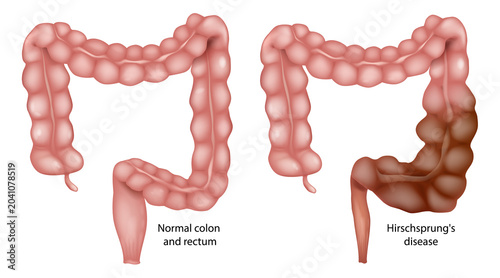 Foto Hirschsprung Disease Medical Illustration Comparing Normal Colon and Congenital Aganglionic Megacolon