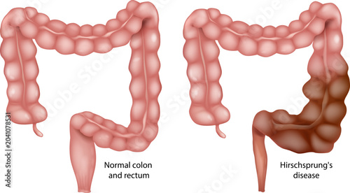 Foto Hirschsprung Disease Medical Illustration Comparing Normal Colon and Congenital Aganglionic Megacolon