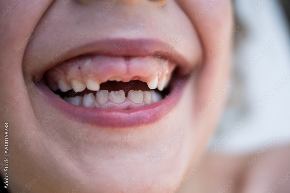 Fototapeta premium Close up of a boy smiling with missing teeth 