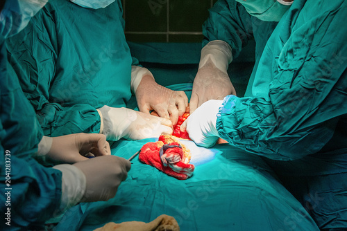 Medical team performing cesarean section in hospital operating room. Surgeons delivering baby through surgical incision under sterile conditions during childbirth.