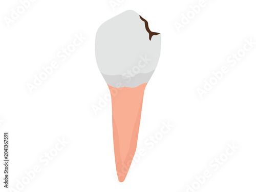 Human Tooth Decay Cavity Illustration
