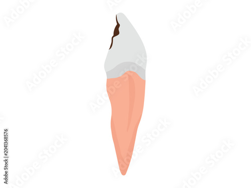 Human Tooth Cavity Clip Art