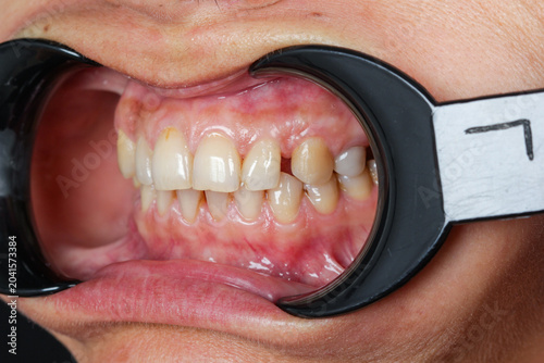 Close-up human teeth showing dental crowding, misalignment and malocclusion during dental examination with cheek retractors. Orthodontics, dentistry, oral health, dental treatment, bite correction