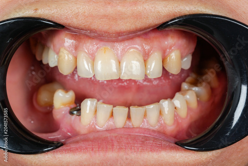 Close-up human teeth showing dental crowding, misalignment and malocclusion during dental examination with cheek retractors. Orthodontics, dentistry, oral health, dental treatment, bite correction