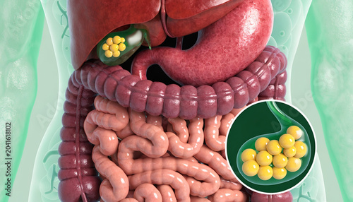 3D Anatomy Illustration Gallstones in Gallbladder with Human Digestive System Illustration
