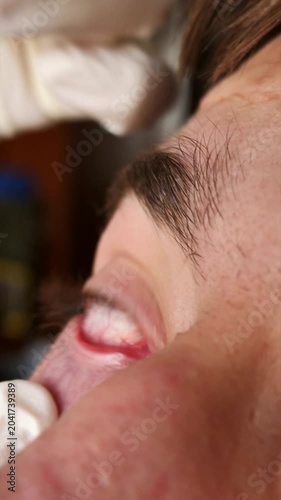 Eye drops. Close-up of a young man using eye drops to treat vision problems. Eye care and medications for treatment. Relief of eye fatigue, irritation, and allergies.