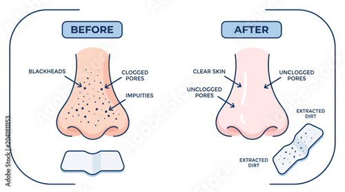 Tableau sur toile Nose Before and After Pore Strip Treatment: Blackheads to Clear Skin