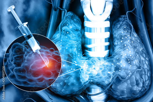Foto Medical professional administering a targeted syringe injection into an inflamed human thyroid gland for treatment