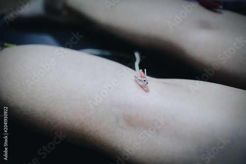 Tableau sur toile Electroacupuncture therapy on a woman, needles stimulated by a machine for relaxation and wellness