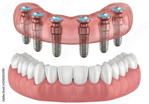 All on six dental implant system showing the titanium screws and prosthetic arch for full mouth restoration