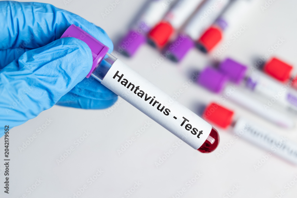 Fototapeta premium Hantavirus Test Sample in Medical Laboratory