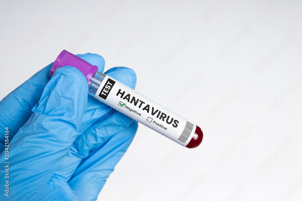 Obraz premium Gloved hand holding a blood sample tube showing a positive hantavirus test result.