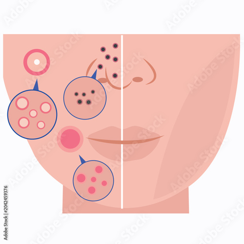 Dermatology chart illustrating different types of facial acne