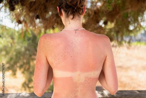 Sunburned skin on a woman back with visible bikini tan lines