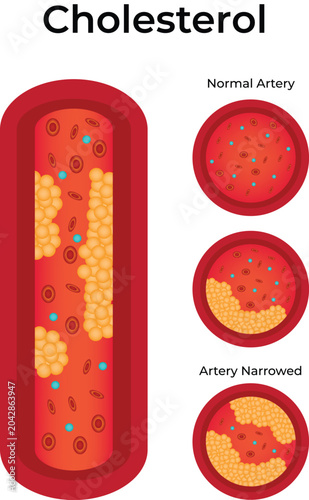 Cholesterol Plaque Narrowing Artery Illustration