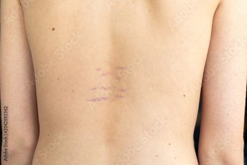 Teenage's back with striae distensae (striae rubrae) on skin, stretch marks on back. Concept of impaired skin elasticity during puberty. Close up