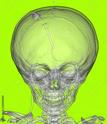 Fotografija 3D CT Scan of Pediatric Skull with Ventriculoperitoneal Shunt