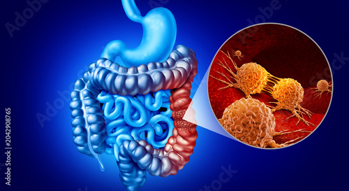 Fotografía Colon Cancer Screening concept featuring colorectal and large intestine colonosc