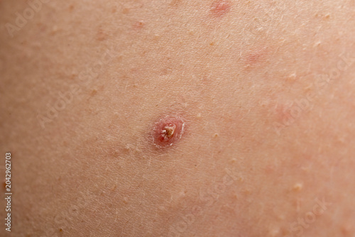 Εκτύπωση καμβά Pimple on pores with pustule and bumps