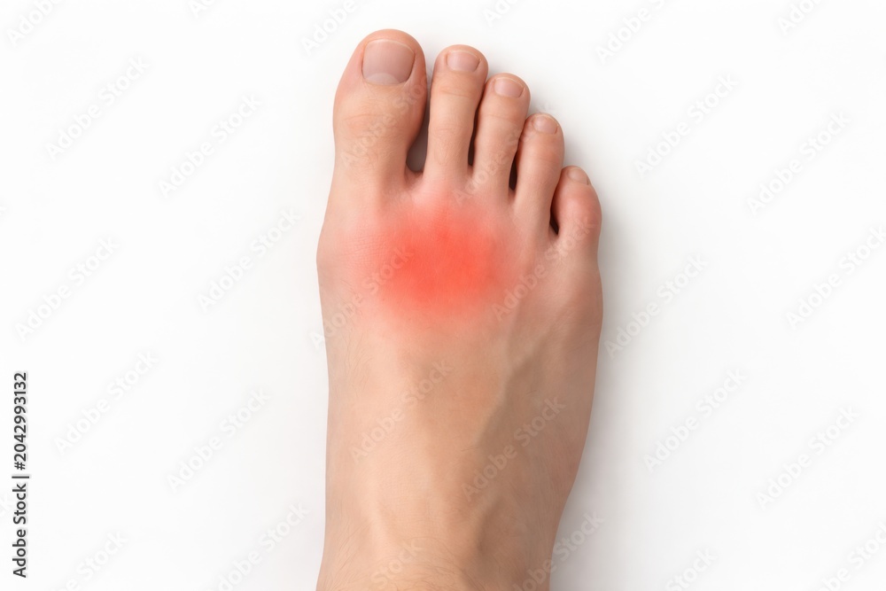 Obraz premium Close-up view of a human foot showing red swelling on the big toe, suggesting inflammation or gout, with a clean white background