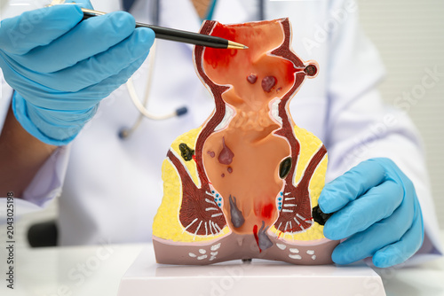Cuadro en lienzo Asian doctor with rectum and hemorrhoid human anatomy model at hospital, inflamed vascular structure