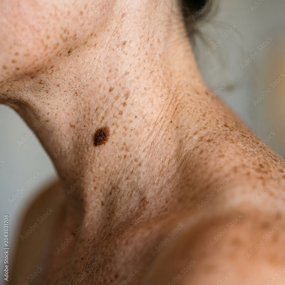 Fototapeta premium Closeup of a womans neck with freckles and a prominent mole, showing skin texture and sun damage