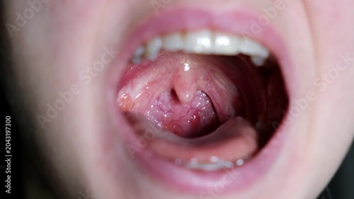 Close up of an open mouth showing inflamed tonsils and throat. Medical examination, oral health, sore throat. Palatine uvula. Removed tonsils. A phoniatrist checks the ligaments and speech apparatus