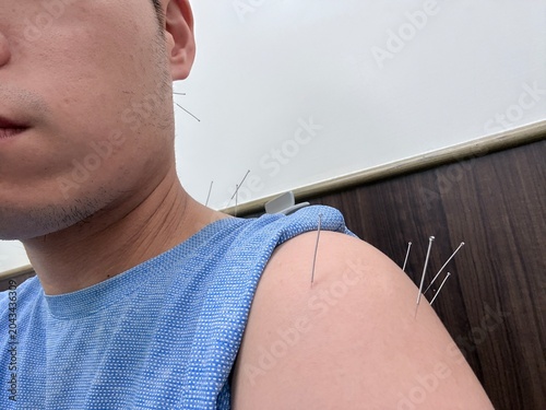 Fotografía Close up of traditional acupuncture therapy on male shoulder