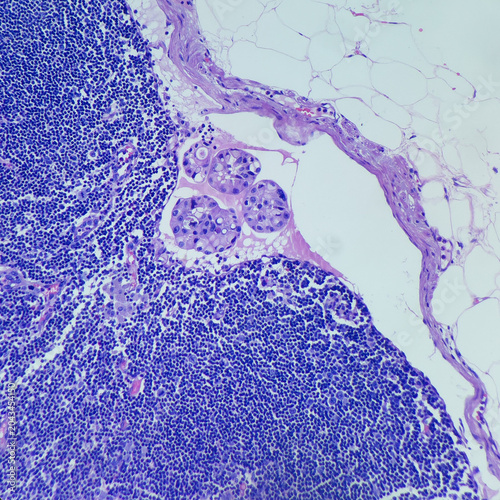 Camera photo of lymph node, showing metastatic carcinoma in subcapsular spaces, magnification 200x, photograph through a microscope