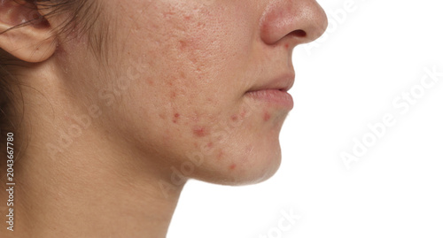 Obraz na płótnie Close up side view portrait of brunette woman with acne scars, inflamed pimples, deep pores and problematic skin on white background