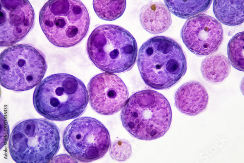 Microscopic view of multiple myeloma cancer cells with abnormal plasma cell structures