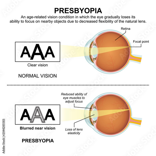 Принти на полотні Presbyopia, Eye Vision Flashcard Illustration