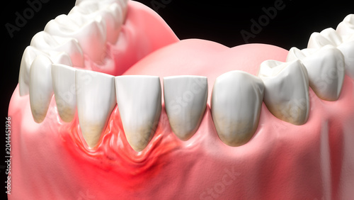 3d illustration of teeth and oral health showing gum disease and inflammation.