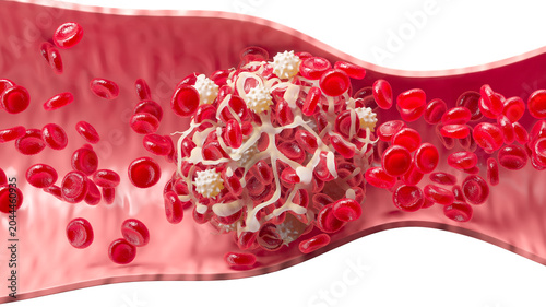 Photos 3D illustration of a blood clot formation with red blood cells trapped in a fibrin mesh inside a blood vessel