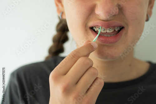 Konstfotografi A teenage girl uses an interdental brush to clean between her braces at home, demonstrating proper oral hygiene and orthodontic care