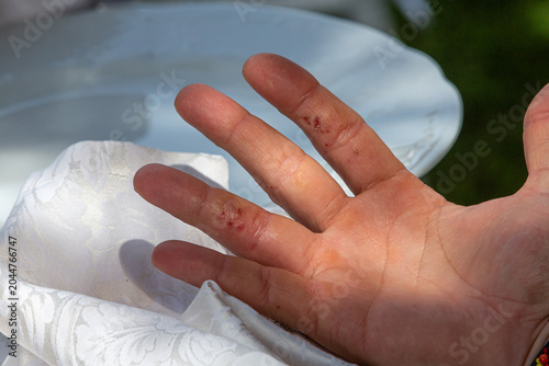 Hand showing skin wounds and blisters
