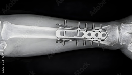 Film X-ray showing arm fracture repaired with plate, screws, and internal fixation