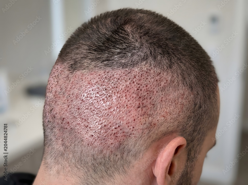 Fototapeta premium Hair Transplant in Crown Area Showing Early Recovery Stage
