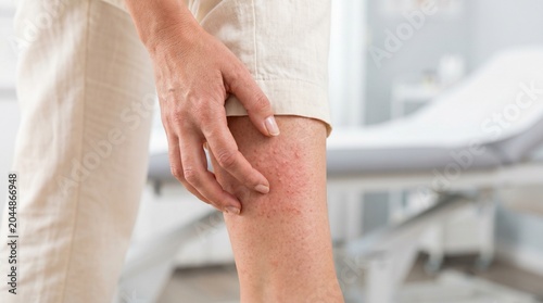 Close up of woman scratching red itchy skin rash on leg at medical clinic for allergy or dermatitis treatment