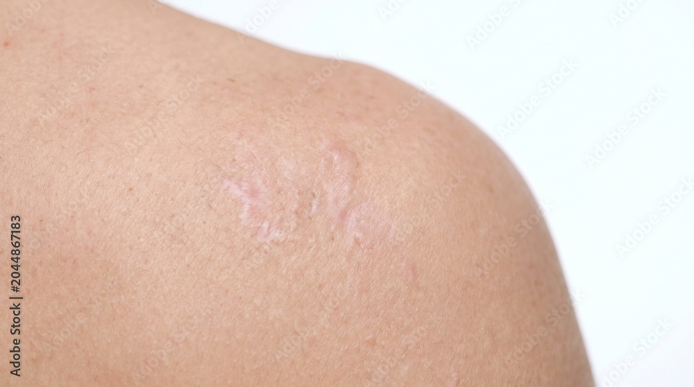 Fototapeta premium Close-up of a person's shoulder with distinct light-colored keloid scars on skin