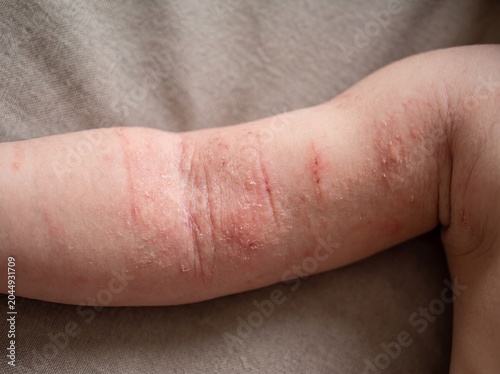 A professional photography close-up shot of the inner arm creases of a young child suffering from Atopic Dermatitis, displaying patches of dry, red, and intensely irritated skin with visible scratch m