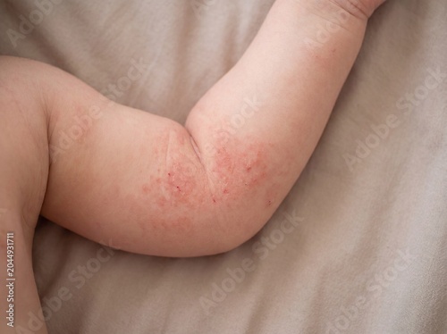 A professional photography close-up shot of the inner arm creases of a young child suffering from Atopic Dermatitis, displaying patches of dry, red, and intensely irritated skin with visible scratch m