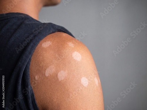 A professional photography close-up shot of a person's shoulder showing Tinea Versicolor, a fungal infection presenting as a cluster of small, oval, discolored spots that are lighter than the surround