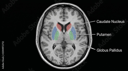 Human brain mri scan showing caudate nucleus putamen globus pallidus