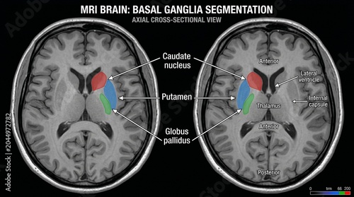 Mri brain basal ganglia segmentation showing caudate nucleus putamen