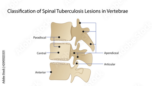 Konstfotografi Classification of Spinal Tuberculosis Lesions in Vertebrae 
Educational anatomy diagram demonstrating the classification of spinal tuberculosis lesions and their characteristic distribution